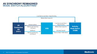 17
AV SYNCHRONY REIMAGINED
MODE SWITCH ALGORITHMS1
Micra™ AV and Micra™ VR Transcatheter Pacing Systems
 