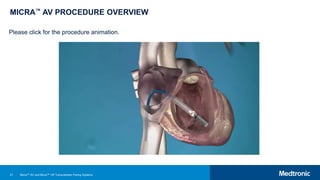 21
MICRA™ AV PROCEDURE OVERVIEW
Please click for the procedure animation.
Micra™ AV and Micra™ VR Transcatheter Pacing Systems
 