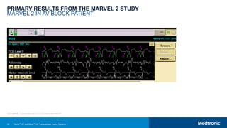 33
PRIMARY RESULTS FROM THE MARVEL 2 STUDY
MARVEL 2 IN AV BLOCK PATIENT
Note: MARVEL 2 clinical data slides were presented at AHA 2019.25
Micra™ AV and Micra™ VR Transcatheter Pacing Systems
 