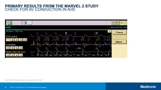 34
PRIMARY RESULTS FROM THE MARVEL 2 STUDY
CHECK FOR AV CONDUCTION IN AVB
Note: MARVEL 2 clinical data slides were presented at AHA 2019.25
Micra™ AV and Micra™ VR Transcatheter Pacing Systems
 