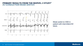 36
PRIMARY RESULTS FROM THE MARVEL 2 STUDY7
AV CONDUCTION MODE SWITCH
Mode switch to VDD in
patient with intermittent AV
block.
Note: MARVEL 2 clinical data slides were presented at AHA 2019.25
Micra™ AV and Micra™ VR Transcatheter Pacing Systems
 