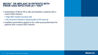 84
MICRA™ VR IMPLANT IN PATIENTS WITH
PRIOR CIED INFECTION (N = 105)42
 Implantation of Micra VR is safe and feasible in patients with a
recent CIED infection:
 High 99% implant success rate
 No recurrent infections requiring Micra VR removal
 Leadless pacemakers appear to be a safe pacing alternative for
patients with a recent CIED infection
Micra™ AV and Micra™ VR Transcatheter Pacing Systems
 