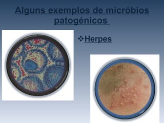 Alguns exemplos de micróbios patogénicos  Herpes 