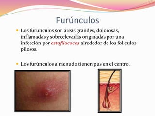 Furúnculos
 Los furúnculos son áreas grandes, dolorosas,
inflamadas y sobreelevadas originadas por una
infección por estafilococos alrededor de los folículos
pilosos.
 Los furúnculos a menudo tienen pus en el centro.
 