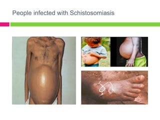 People infected with Schistosomiasis 
 
