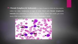  Chronic lymphocytic leukaemia is a type of cancer in which the bone marrow
makes too many lymphocytes (a type of white blood cell). Chronic lymphocytic
leukemia (also called CLL) is a blood and bone marrow disease that usually gets worse
slowly. CLL is one of the most common types of leukemia in adults.
 