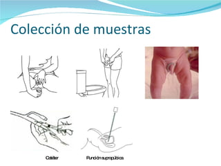 Colección de muestras  Punción suprapúbica Catéter 