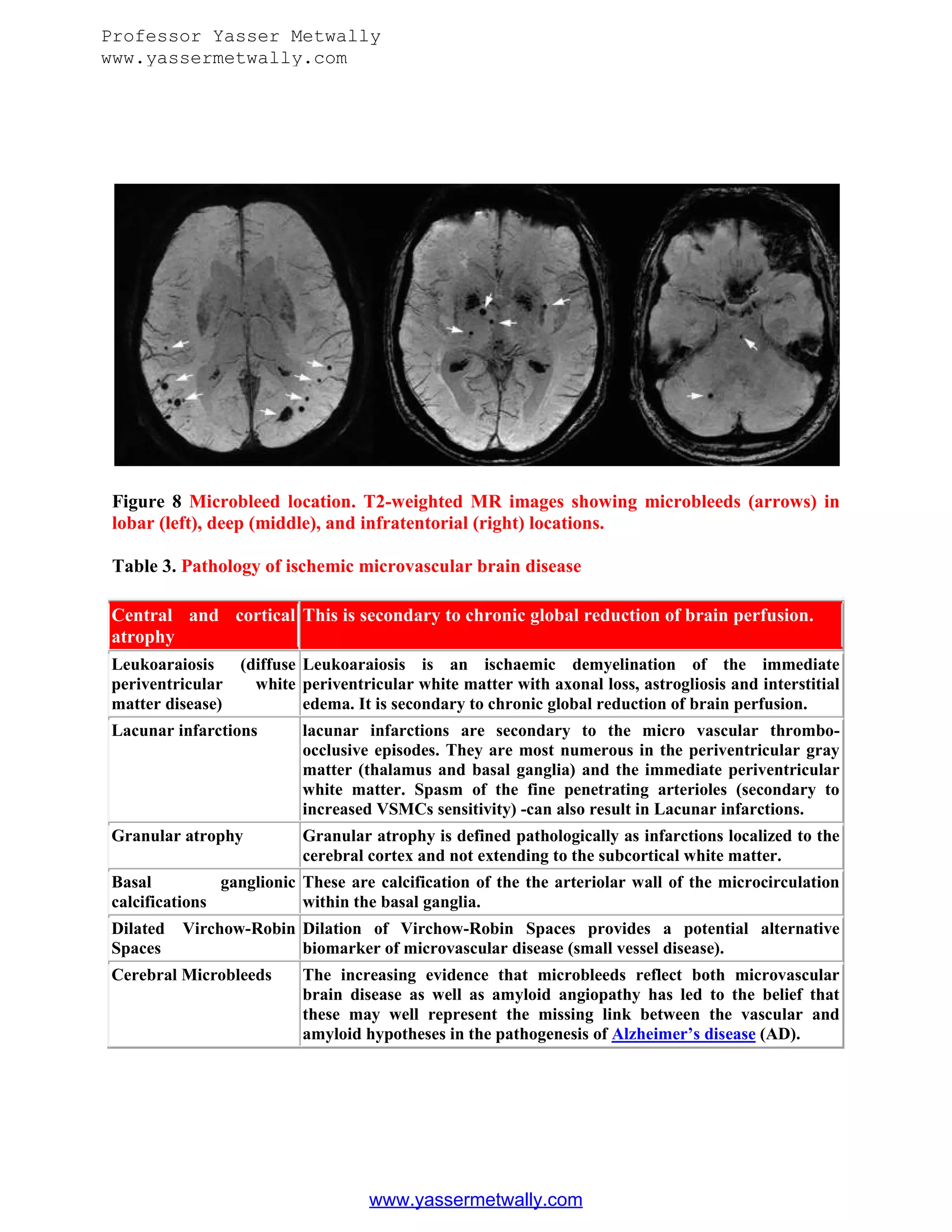 Radiological pathology of cerebral microbleeds | PDF