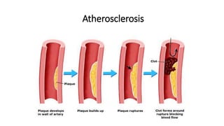 Atherosclerosis
 