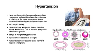 Hypertension
• Hypertension results from excessive arteriolar
constriction and peripheral vascular resistance
in relation to the blood volume and, when
sustained, leads to hypertensive cardiovascular
• BP >140/90 mmHg
• Genetic factors. • High salt intake. • Alcohol
excess. • Obesity. • Lack of exercise.• Impaired
intrauterine growth.
• Benign & malignant hypertension
• hyaline arteriolosclerosis. (benign)
• hyperplastic arteriolosclerosis and fibrinoid
necrosis (malignant)
 