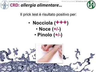 CRD: allergia alimentare…
Università degli Studi di Firenze SOD Immunoallergologia Winter School SIAIC 20 Febbraio 2010
Il prick test è risultato positivo per:
• Nocciola (+++)
• Noce (+/-)
• Pinolo (+/-)
 