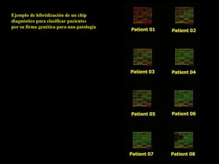Ejemplo de hibridización de un chip
diagnóstico para clasificar pacientes
por su firma genética para una patología
 