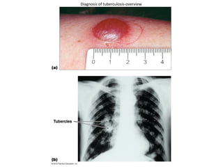 Diagnosis of tuberculosis-overview
 