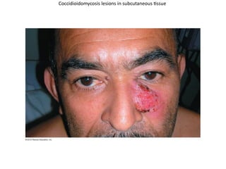 Coccidioidomycosis lesions in subcutaneous tissue
 