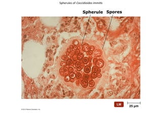 Spherules of Coccidioides immitis
Spherule Spores
 