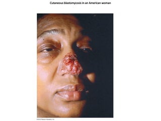 Cutaneous blastomycosis in an American woman
 