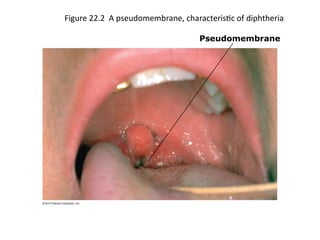 Figure 22.2 A pseudomembrane, characteristic of diphtheria
Pseudomembrane
 
