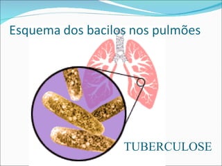 TUBERCULOSE
 