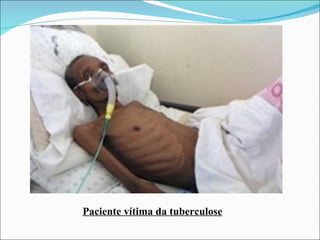 Paciente vítima da tuberculose
 