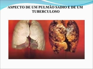 ASPECTO DE UM PULMÃO SADIO E DE UM
           TUBERCULOSO
 