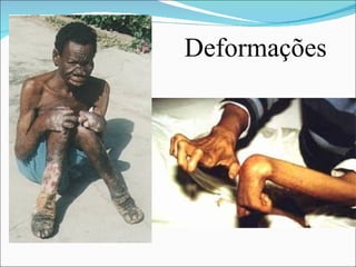Deformações
 