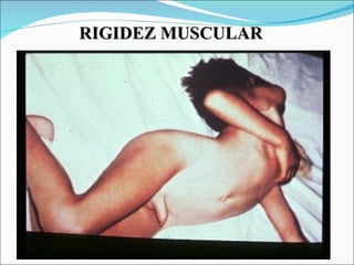 RIGIDEZ MUSCULAR
 