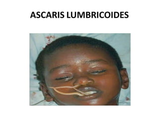 ASCARIS LUMBRICOIDES
 