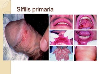 Sífilis primaria

 