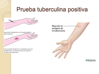Prueba tuberculina positiva

 