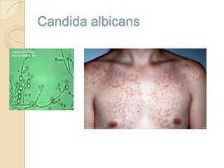 Candida albicans

 