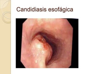 Candidiasis esofágica

 