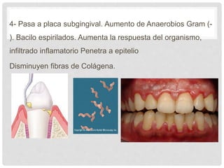4- Pasa a placa subgingival. Aumento de Anaerobios Gram (-
). Bacilo espirilados. Aumenta la respuesta del organismo,
infiltrado inflamatorio Penetra a epitelio
Disminuyen fibras de Colágena.
 