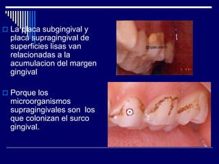  La placa subgingival y
placa supragingival de
superficies lisas van
relacionadas a la
acumulacion del margen
gingival
 Porque los
microorganismos
supragingivales son los
que colonizan el surco
gingival.
 