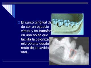  El surco gingival deja
de ser un espacio
virtual y se transforma
en una bolsa que
facilita la colonización
microbiana desde el
resto de la cavidad
oral.
 