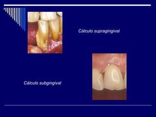 Cálculo supragingival
Cálculo subgingival
 