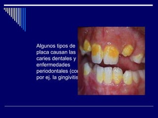 Algunos tipos de
placa causan las
caries dentales y
enfermedades
periodontales (como
por ej. la gingivitis).
 