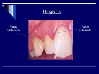 Papila
inflamada
Placa
bacteriana
Gingivitis
 