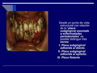 Desde un punto de vista
estructural con relación
de la “placa
subgingival asociada
a enfermedades
periodontales” es
posible distinguir tres
zonas:
I. Placa subgingival
adherida al diente.
II. Placa subgingival
adherida al epitelio.
III. Placa flotante
 