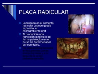 PLACA RADICULAR
 Localizado en el cemento
radicular cuando queda
expuesto, al
microambiente oral
 Al producirse una
retracción gingival o de
forma patológica en el
curso de enfermedades
periodontales.
 Se sitúa preferentemente
en las grandes zonas
interproximales y a lo
largo de la unión
cemento-esmalte.
 