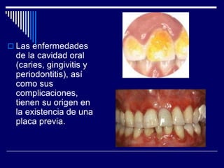  Las enfermedades
de la cavidad oral
(caries, gingivitis y
periodontitis), así
como sus
complicaciones,
tienen su origen en
la existencia de una
placa previa.
 