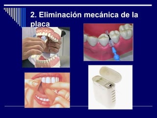 2. Eliminación mecánica de la
placa
 