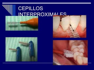 CEPILLOS
INTERPROXIMALES
 
