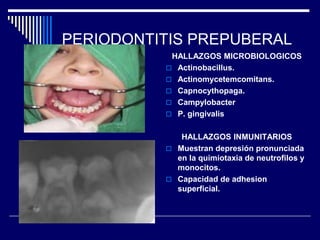 PERIODONTITIS PREPUBERAL
HALLAZGOS MICROBIOLOGICOS
 Actinobacillus.
 Actinomycetemcomitans.
 Capnocythopaga.
 Campylobacter
 P. gingivalis
HALLAZGOS INMUNITARIOS
 Muestran depresión pronunciada
en la quimiotaxia de neutrofilos y
monocitos.
 Capacidad de adhesion
superficial.
 