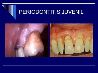 PERIODONTITIS JUVENIL
 