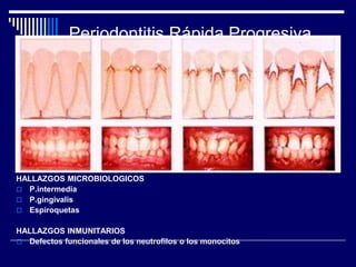 Periodontitis Rápida Progresiva.
HALLAZGOS MICROBIOLOGICOS
 P.intermedia
 P.gingivalis
 Espiroquetas
HALLAZGOS INMUNITARIOS
 Defectos funcionales de los neutrofilos o los monocitos
 