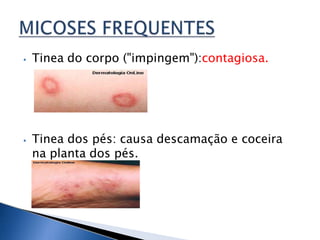 ⦁ Tinea do corpo ("impingem"):contagiosa.
⦁ Tinea dos pés: causa descamação e coceira
na planta dos pés.
 