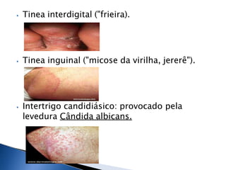 ⦁ Tinea interdigital ("frieira).
⦁ Tinea inguinal ("micose da virilha, jererê").
⦁ Intertrigo candidiásico: provocado pela
levedura Cândida albicans.
 