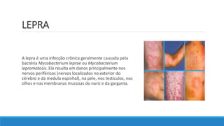 LEPRA
A lepra é uma infecção crônica geralmente causada pela
bactéria Mycobacterium leprae ou Mycobacterium
lepromatosis. Ela resulta em danos principalmente nos
nervos periféricos (nervos localizados no exterior do
cérebro e da medula espinhal), na pele, nos testículos, nos
olhos e nas membranas mucosas do nariz e da garganta.
 