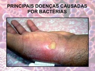 PRINCIPAIS DOENÇAS CAUSADAS
POR BACTÉRIAS
 