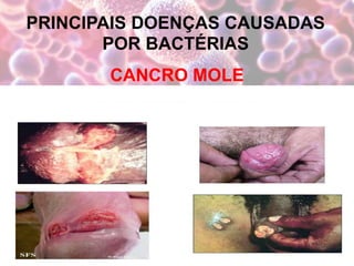 PRINCIPAIS DOENÇAS CAUSADAS
POR BACTÉRIAS
CANCRO MOLE
 